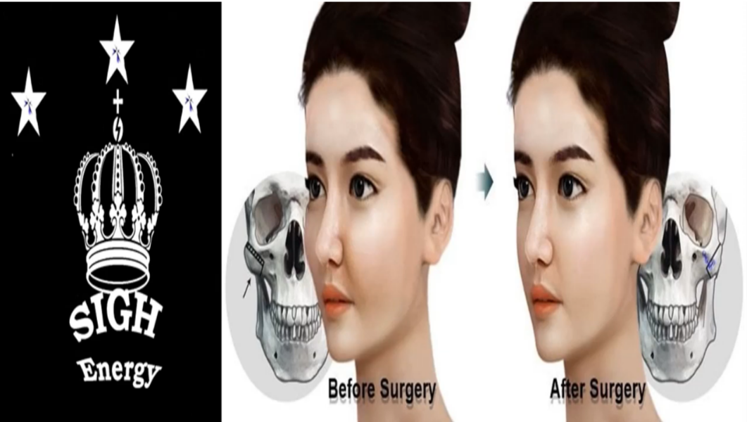 FireShot Capture 006 - Zygoma Reduction.png
