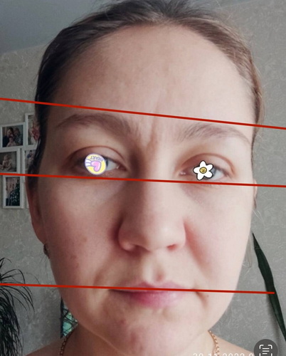 Яркий пример сколиоза костей.jpg