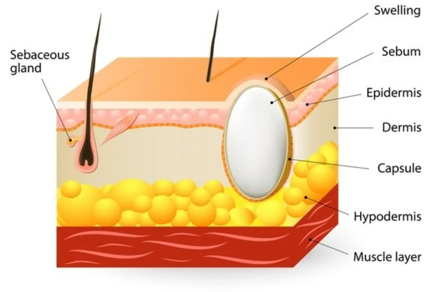 сал киста.png